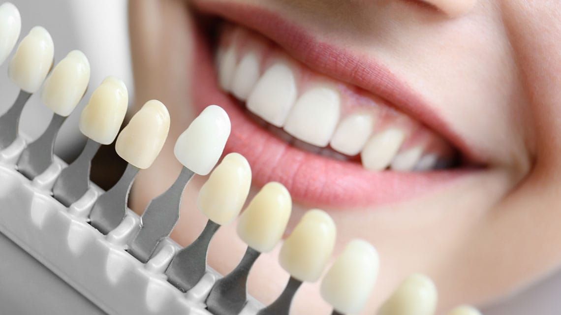 Close-up of a smile with dental veneers being compared to a tooth shade guide in Antalya, Turkey. A perfect example of tooth laminate veneers for a natural, bright smile.