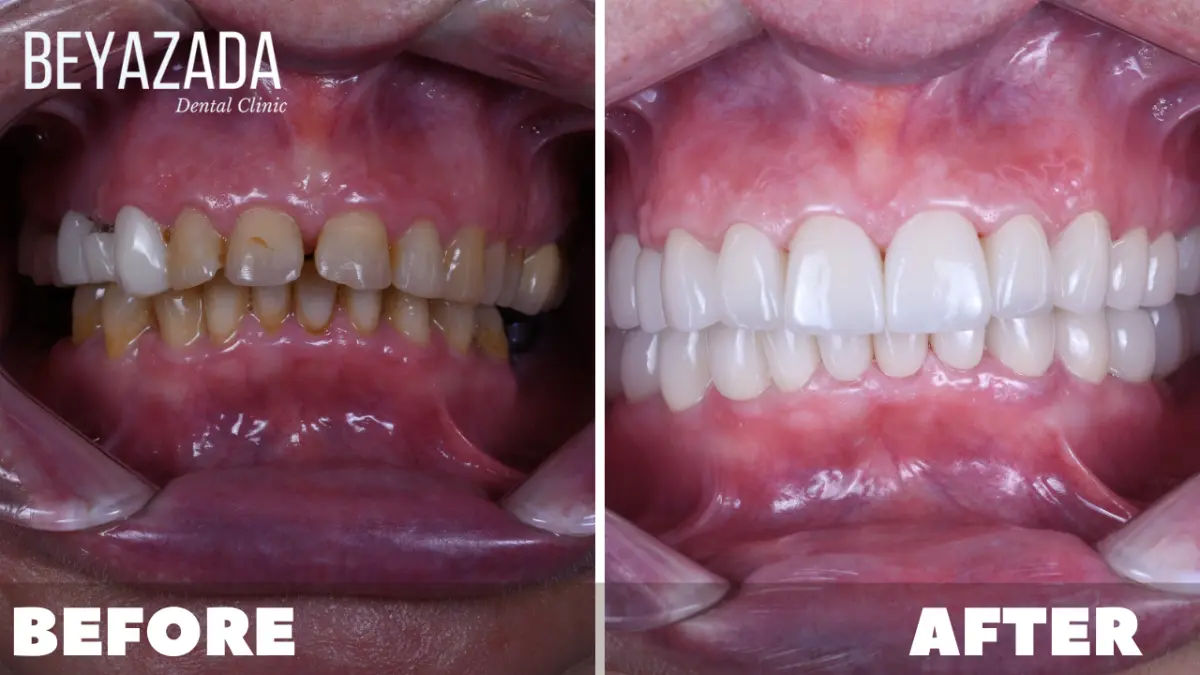 Dental Veneer