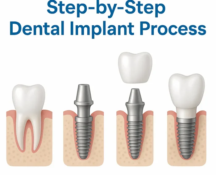 Step-by-step illustration showing dental implant process from tooth extraction to crown placement in four stages