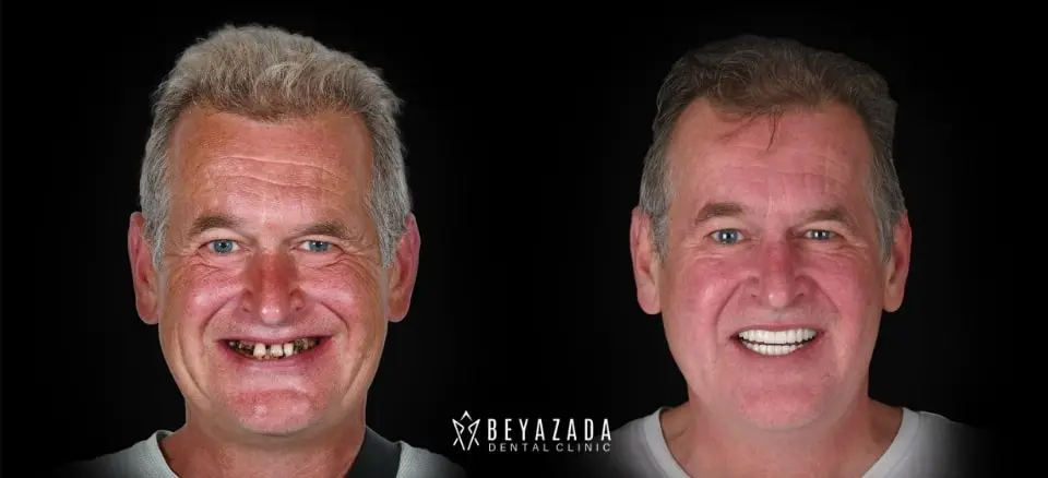 how to heal faster after dental implants in antalya