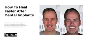 How to heal faster after dental implants?