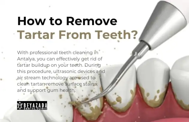 How to remove tartar from teeth turkey