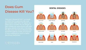 Does gum disease kill you? Risk map starting with bleeding gums