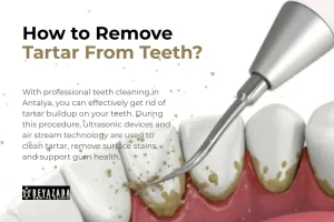 How to remove tartar from teeth?