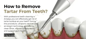 How to remove tartar from teeth?