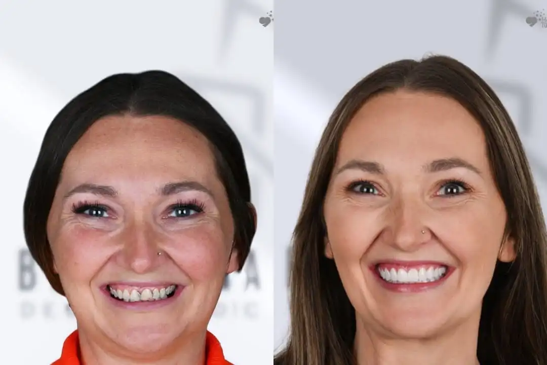 How Long Do Zirconia Crowns Last? how long do zirconia crowns last